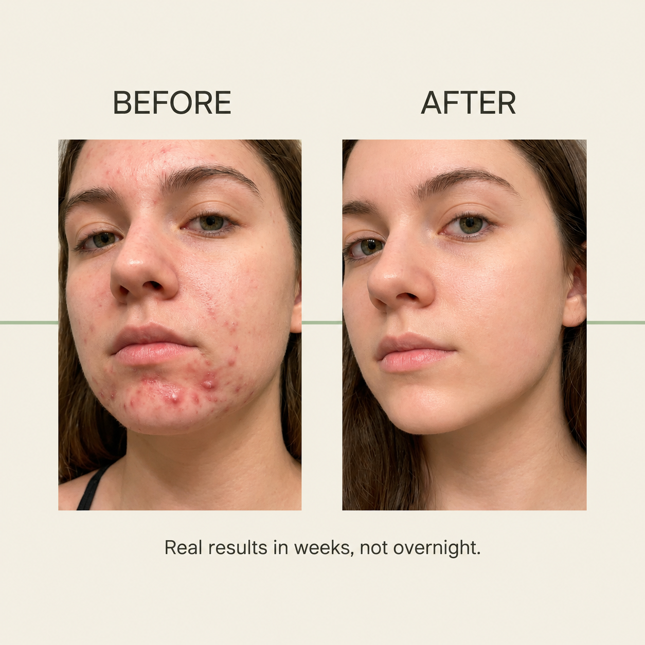 Votocol: Gut-Skin Probiotic for Teen Acne