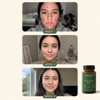 Votocol: Gut-Skin Probiotic for Teen Acne